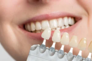 Professional teeth whitening results at Wisconsin Family Dental